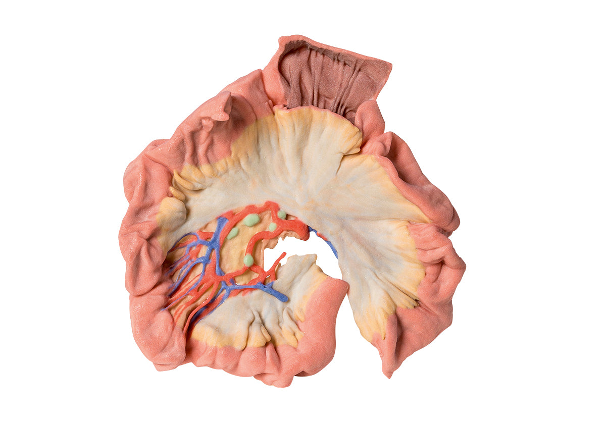 Bowel - Portion of Jejenum