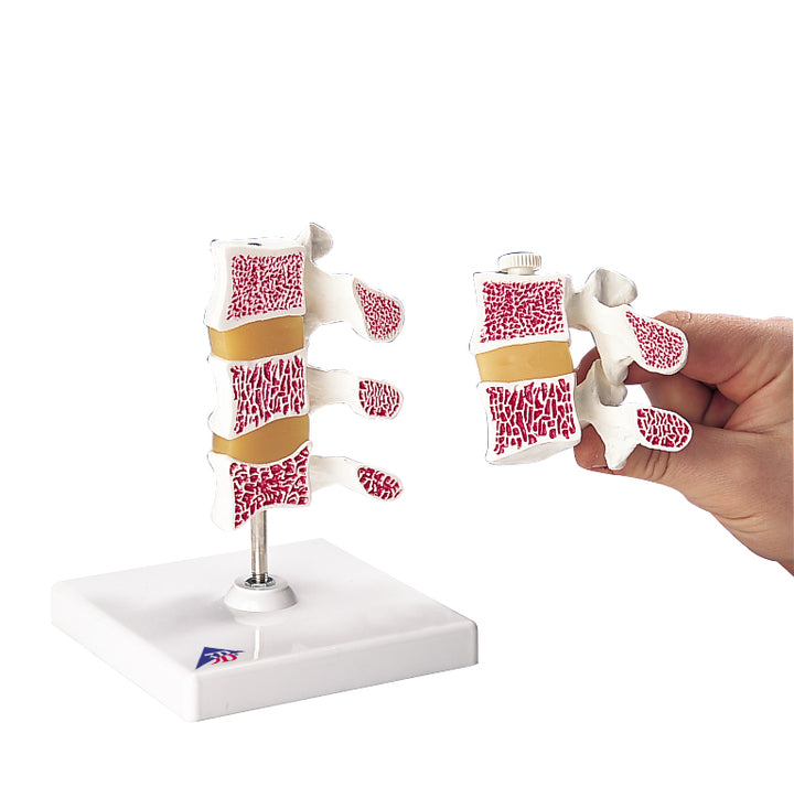 3B Deluxe Osteoporosis Model (3 Vertebrae)