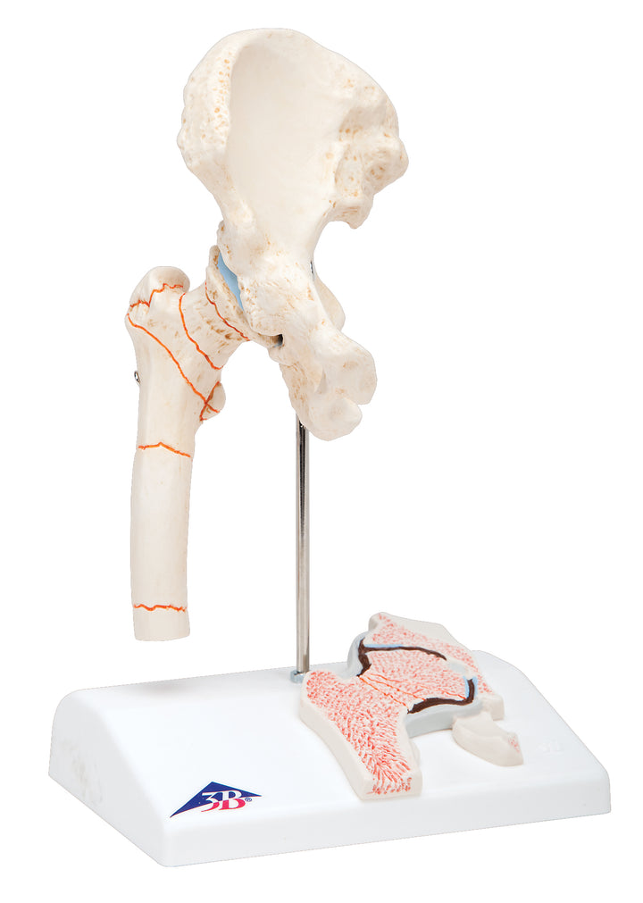 3B Femoral Fracture and Hip Osteoarthritis