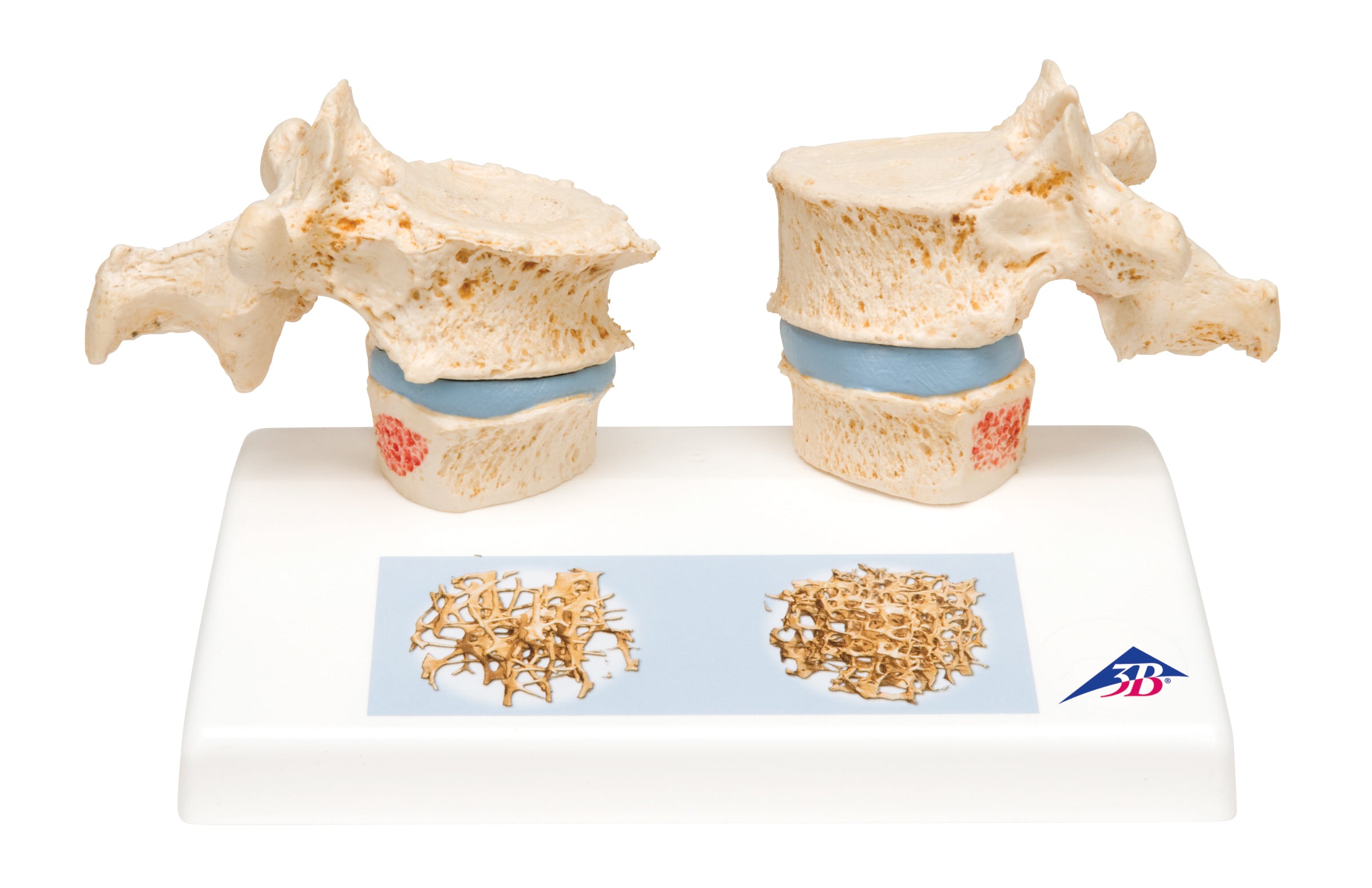 3B Osteoporosis Model