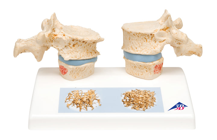 3B Osteoporosis Model