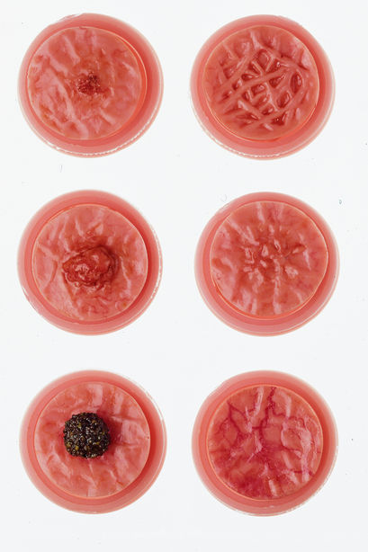 SOMSO CLA-Different Pathological Changes