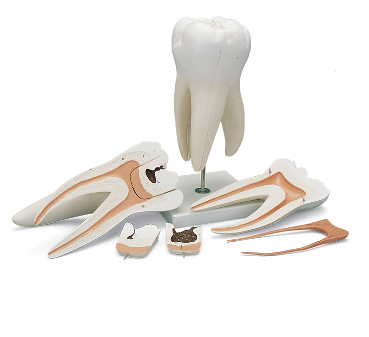 3B Giant Molar w/ Dental Caries 15 times life-size 6-part