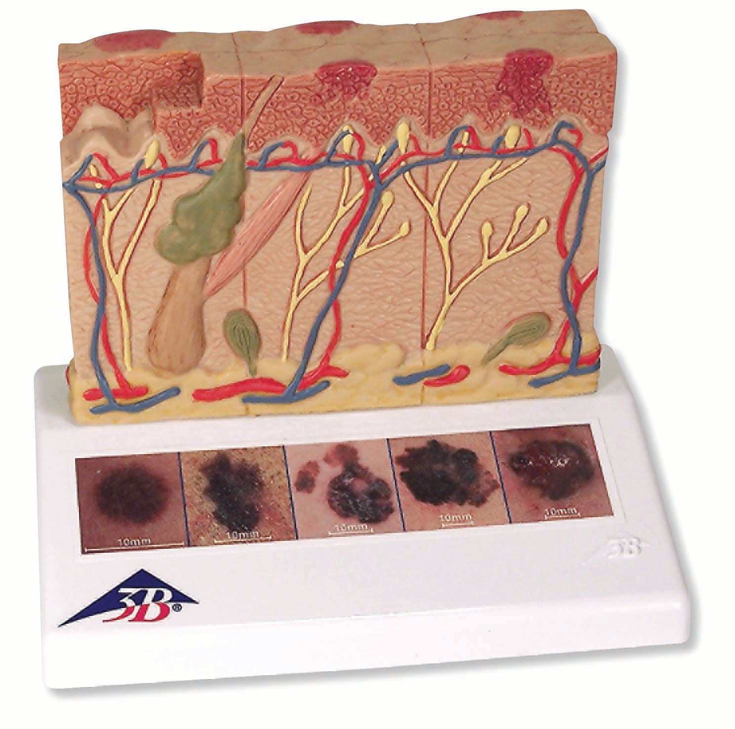 3B Skin Cancer Model