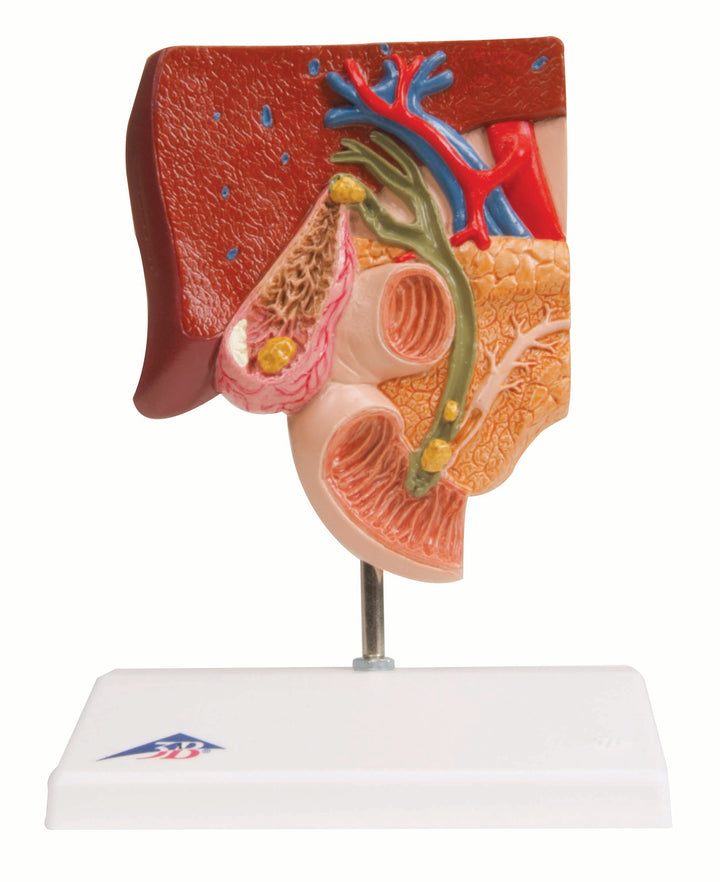 3B Gallstone Model