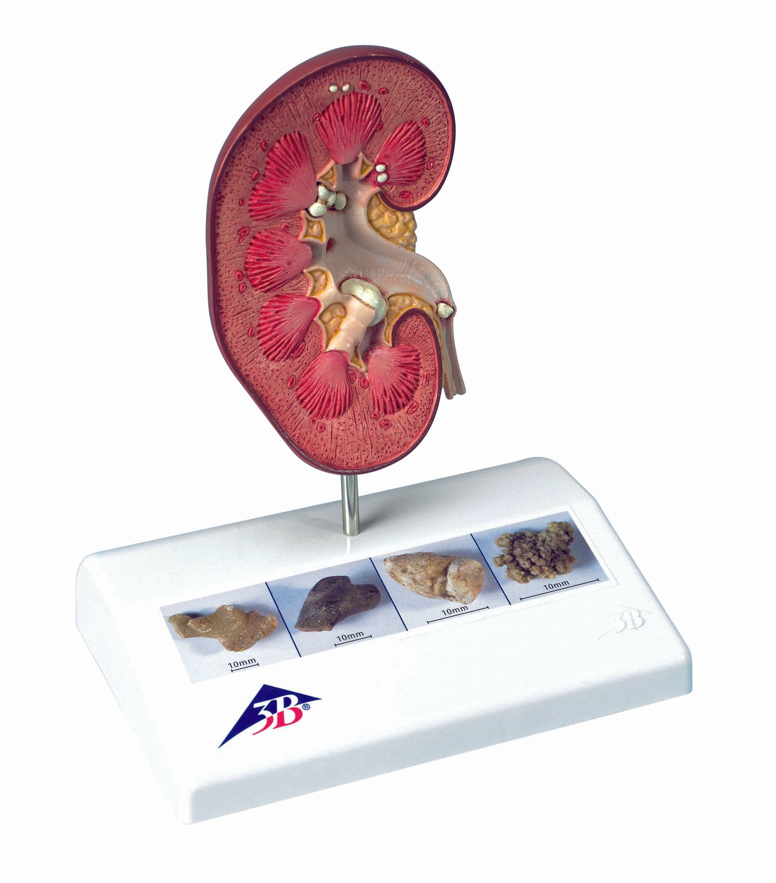 3B Kidney Stone Model