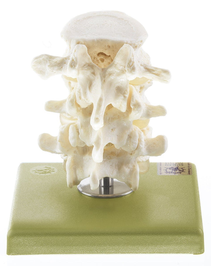 SOMSO Three Lumbar Vertebrae with Discs