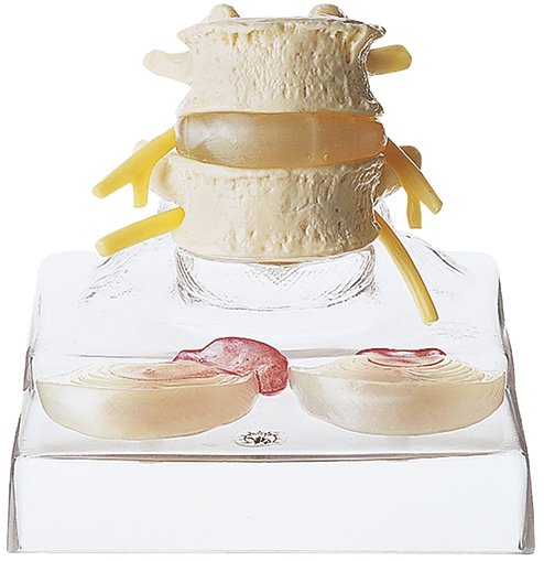 SOMSO Central and Dorsolateral Hernia of Intervertebral Disc
