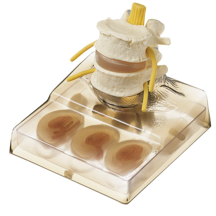 SOMSO Model of Hernia of Intervertebral Disc