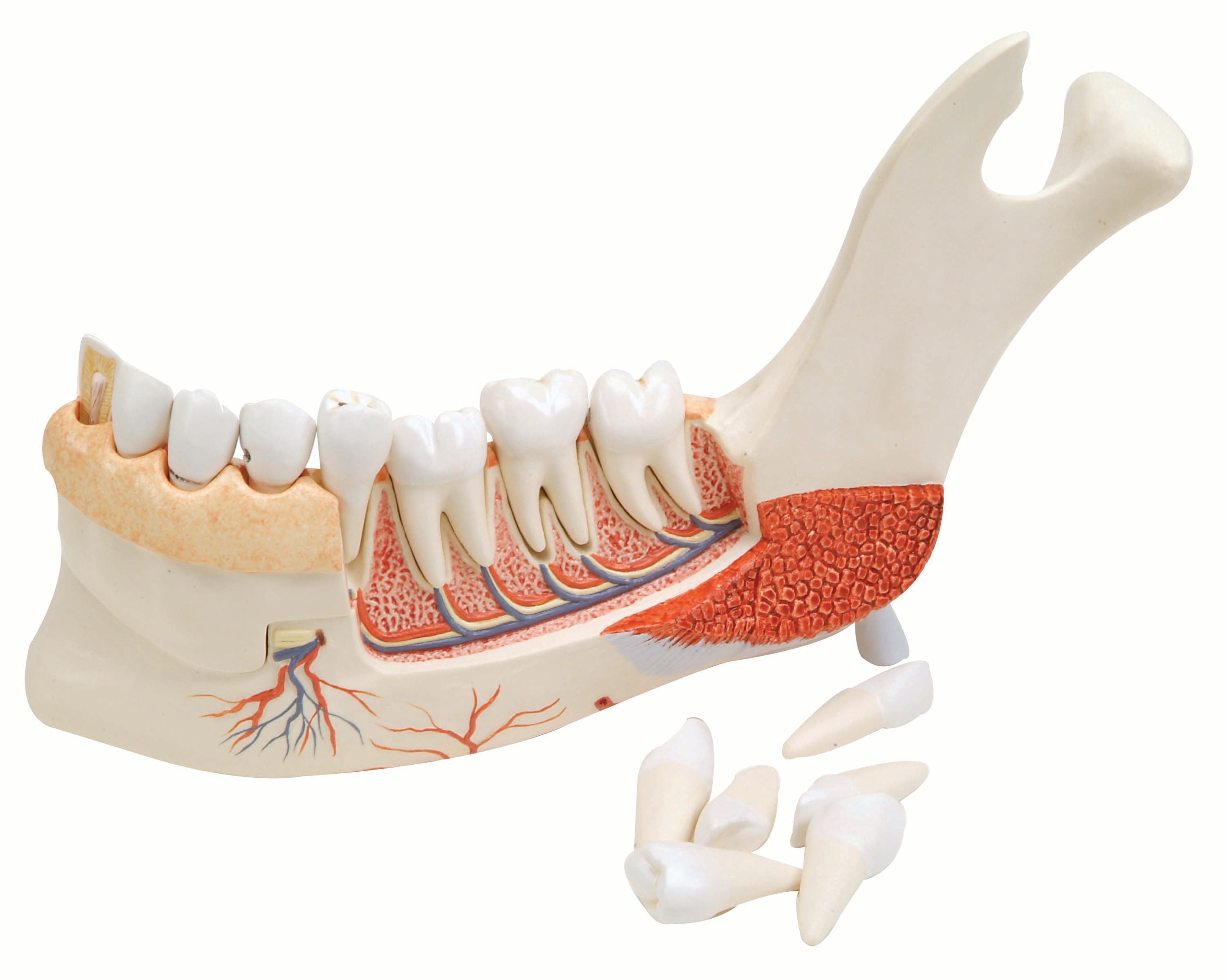 3B Advanced Half Lower Jaw w/ 8 Diseased Teeth 19-Part