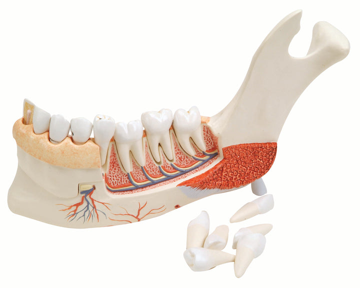 3B Advanced Half Lower Jaw w/ 8 Diseased Teeth 19-Part